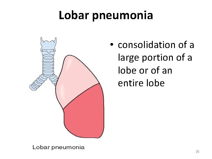 Lobar pneumonia • consolidation of a large portion of a lobe or of an