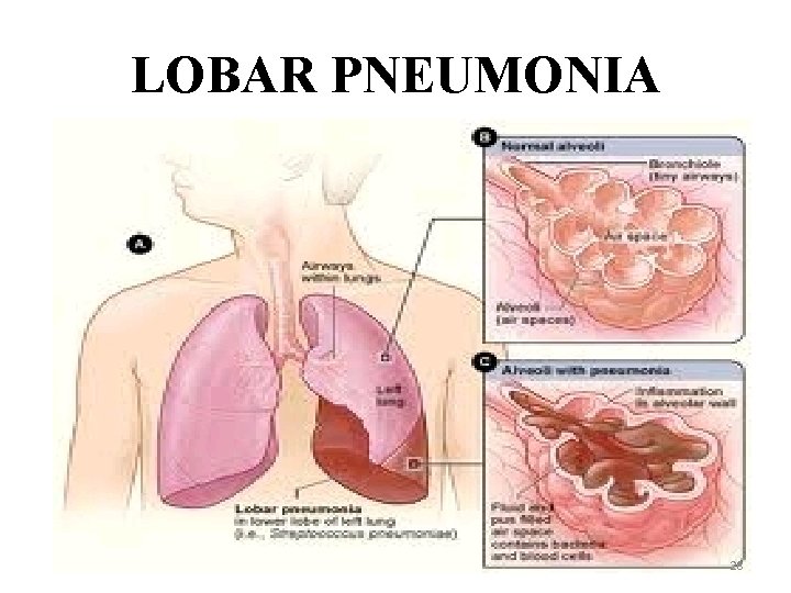 LOBAR PNEUMONIA 28 
