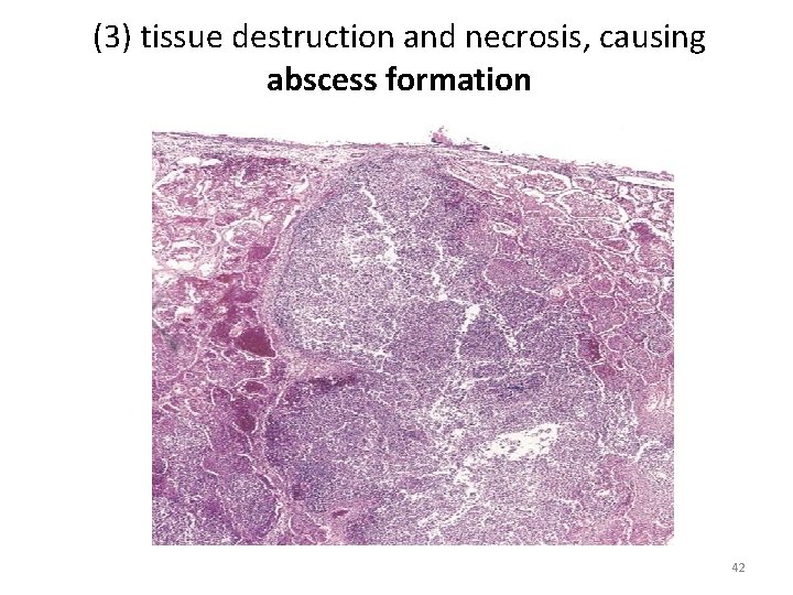 (3) tissue destruction and necrosis, causing abscess formation 42 