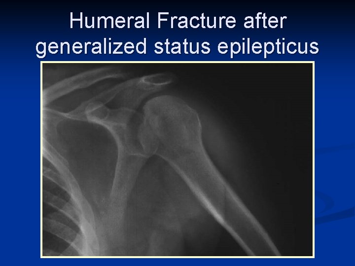 Humeral Fracture after generalized status epilepticus 