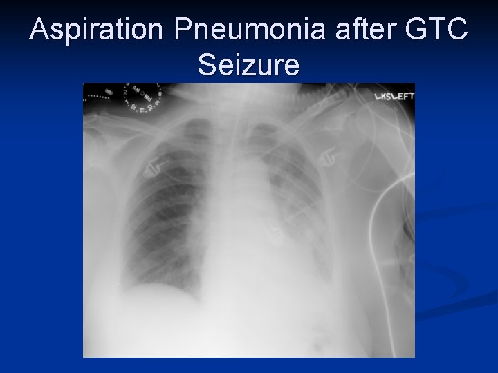 Aspiration Pneumonia after GTC Seizure 