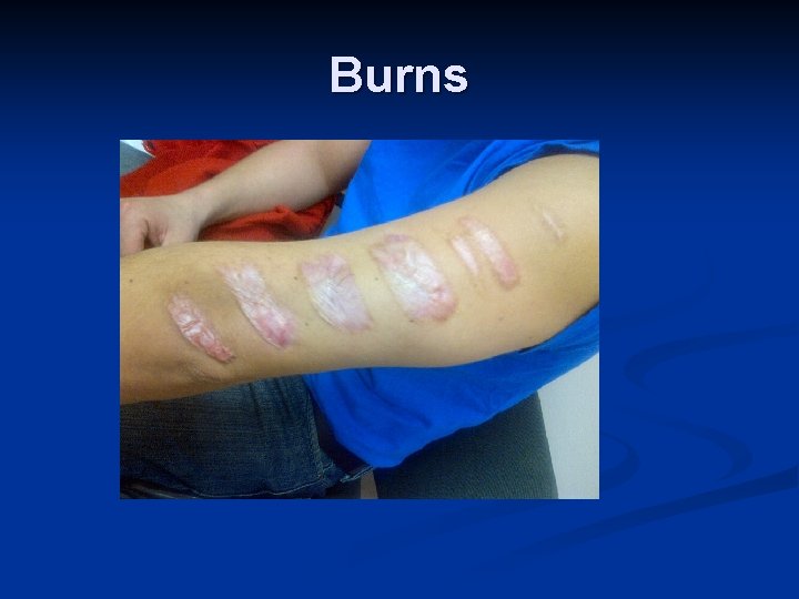 Burns 