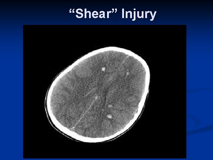 “Shear” Injury 