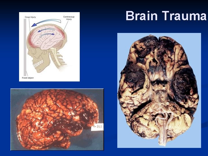 Brain Trauma 