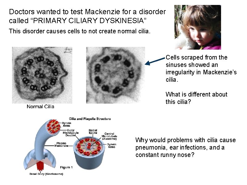 Doctors wanted to test Mackenzie for a disorder called “PRIMARY CILIARY DYSKINESIA” This disorder