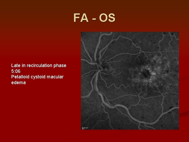 FA - OS Late in recirculation phase 5: 06 Petalloid cystoid macular edema FA - OS Late in recirculation phase 5: 06 Petalloid cystoid macular edema