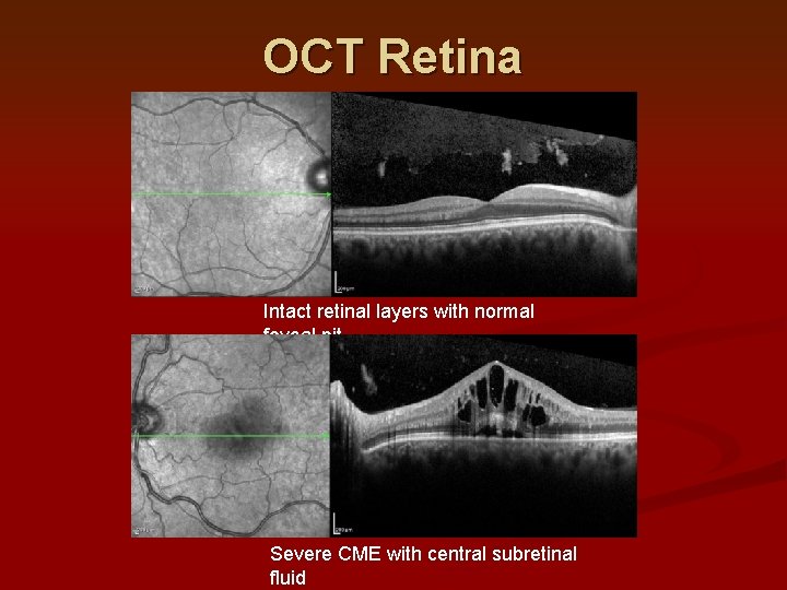 OCT Retina Intact retinal layers with normal foveal pit Severe CME with central subretinal OCT Retina Intact retinal layers with normal foveal pit Severe CME with central subretinal