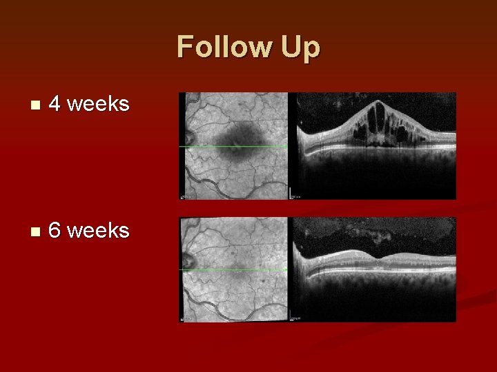 Follow Up n 4 weeks n 6 weeks Follow Up n 4 weeks n 6 weeks