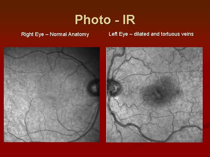 Photo - IR Right Eye – Normal Anatomy Left Eye – dilated and tortuous Photo - IR Right Eye – Normal Anatomy Left Eye – dilated and tortuous