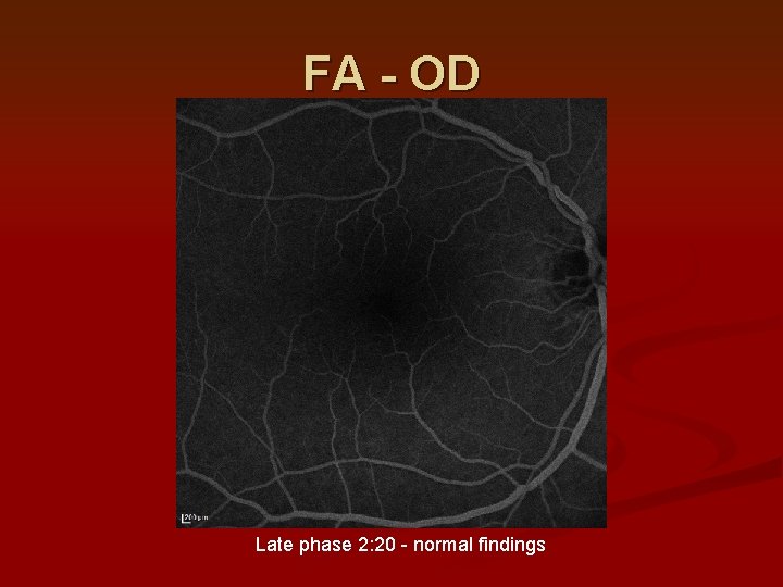 FA - OD Late phase 2: 20 - normal findings FA - OD Late phase 2: 20 - normal findings