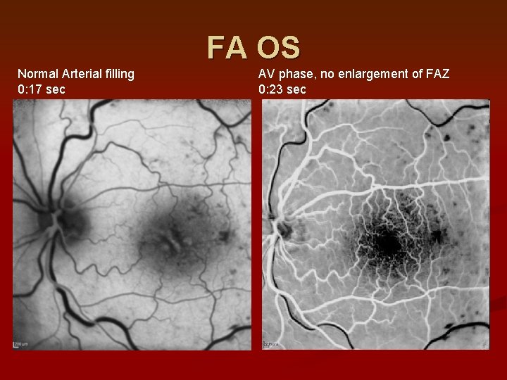 FA OS Normal Arterial filling 0: 17 sec AV phase, no enlargement of FAZ FA OS Normal Arterial filling 0: 17 sec AV phase, no enlargement of FAZ