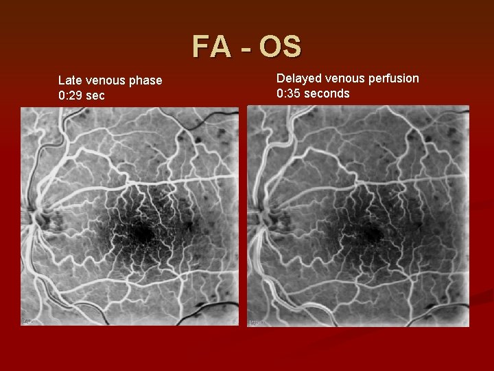 FA - OS Late venous phase 0: 29 sec Delayed venous perfusion 0: 35 FA - OS Late venous phase 0: 29 sec Delayed venous perfusion 0: 35
