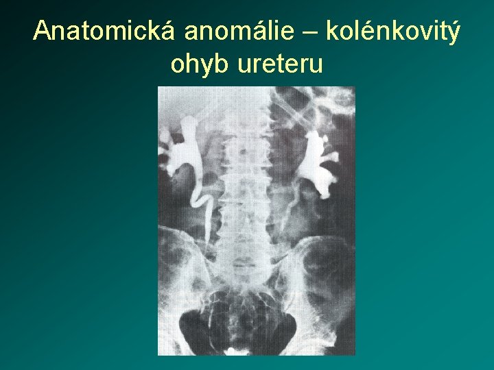 Anatomická anomálie – kolénkovitý ohyb ureteru 