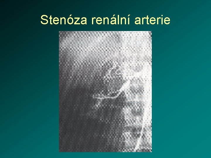 Stenóza renální arterie 