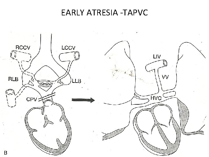 EARLY ATRESIA -TAPVC 