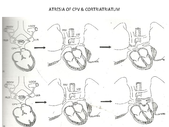 ATRESIA OF CPV & CORTRIATUM 