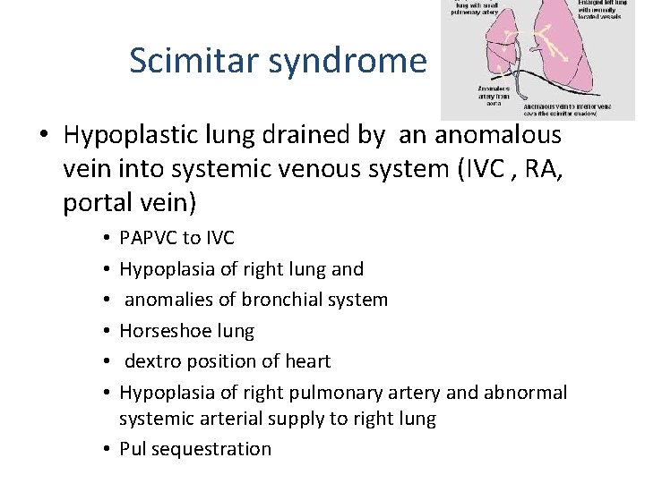 Scimitar syndrome • Hypoplastic lung drained by an anomalous vein into systemic venous system