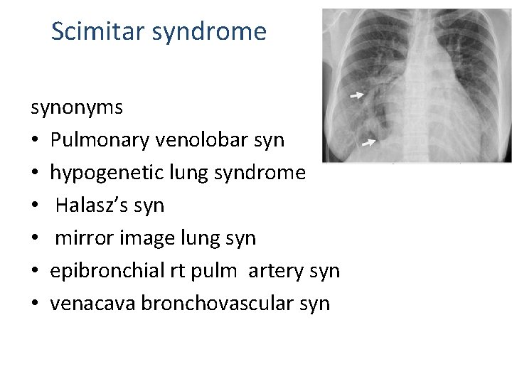 Scimitar syndrome synonyms • Pulmonary venolobar syn • hypogenetic lung syndrome • Halasz’s syn