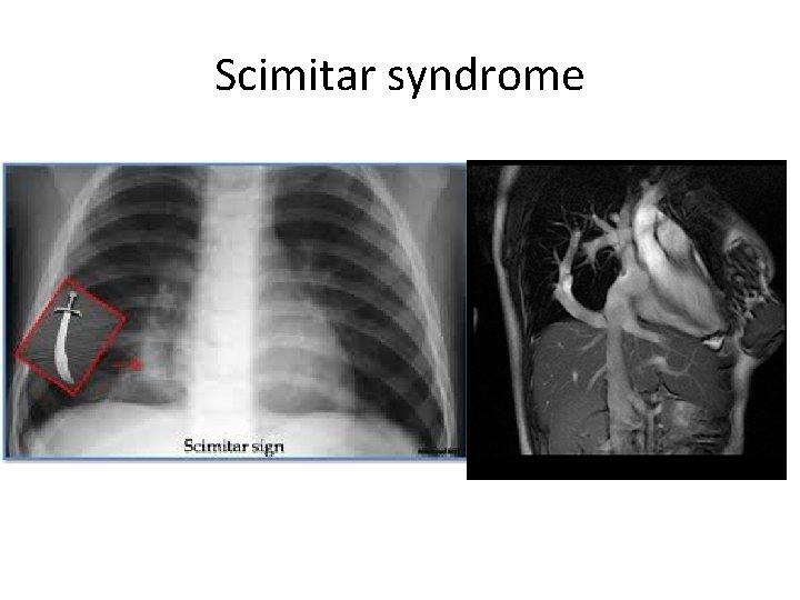 Scimitar syndrome 
