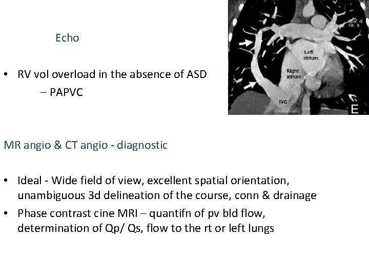Echo • RV vol overload in the absence of ASD – PAPVC MR angio