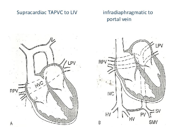 Supracardiac TAPVC to LIV infradiaphragmatic to portal vein 
