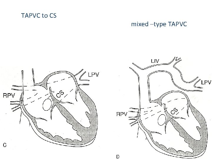 TAPVC to CS mixed –type TAPVC 