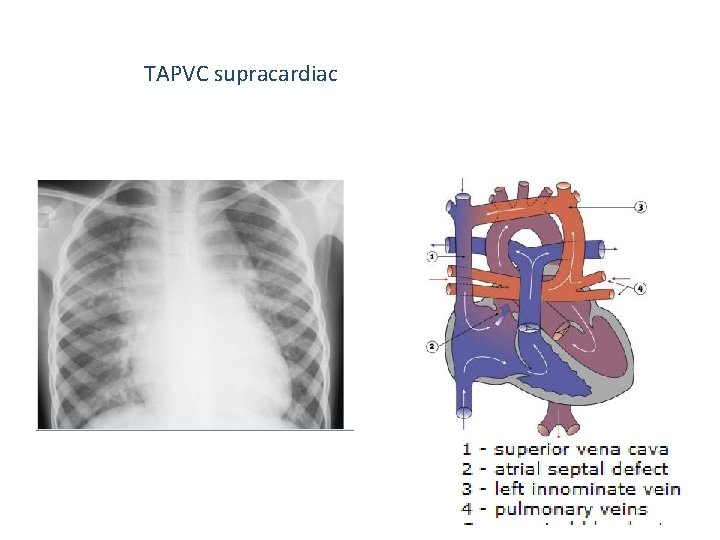 TAPVC supracardiac 