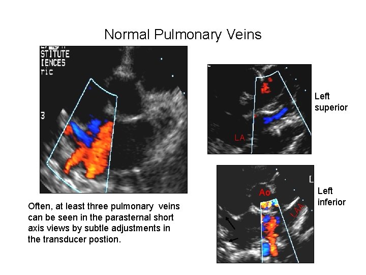 Normal Pulmonary Veins Left superior LA LA Often, at least three pulmonary veins can