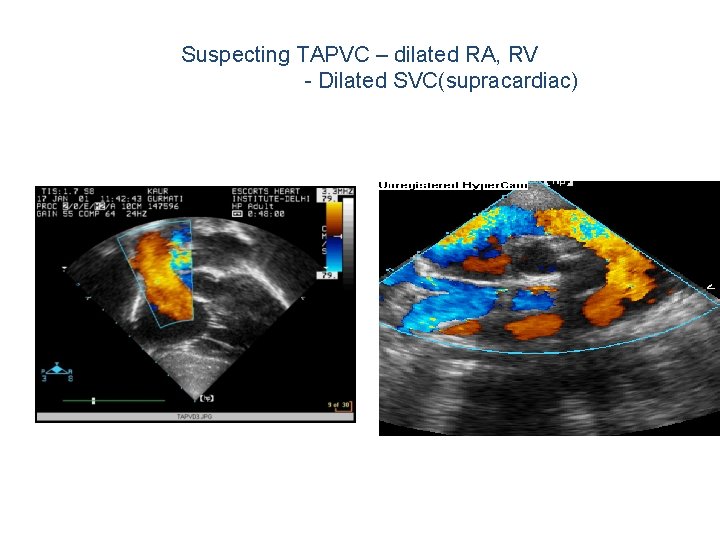 Suspecting TAPVC – dilated RA, RV - Dilated SVC(supracardiac) Suspecting TAPVC – dilated RA, RV - Dilated SVC(supracardiac)