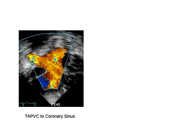 TAPVC to Coronary Sinus 