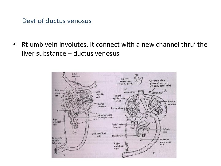 Devt of ductus venosus • Rt umb vein involutes, lt connect with a new