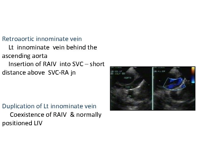 Retroaortic innominate vein Lt innominate vein behind the ascending aorta Insertion of RAIV into