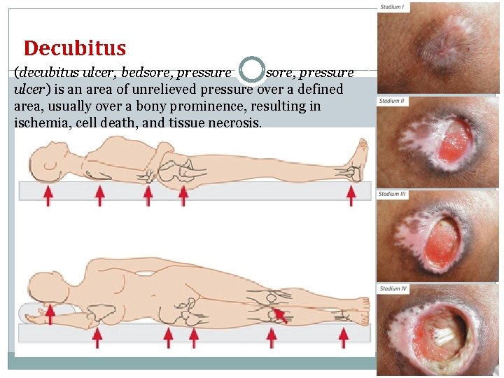 Decubitus (decubitus ulcer, bedsore, pressure ulcer) is an area of unrelieved pressure over a