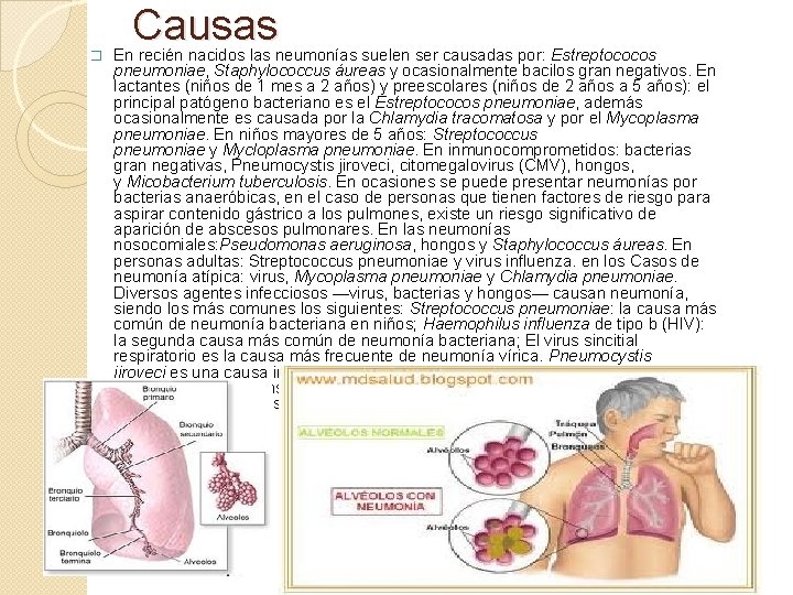 � Causas En recién nacidos las neumonías suelen ser causadas por: Estreptococos pneumoniae, Staphylococcus