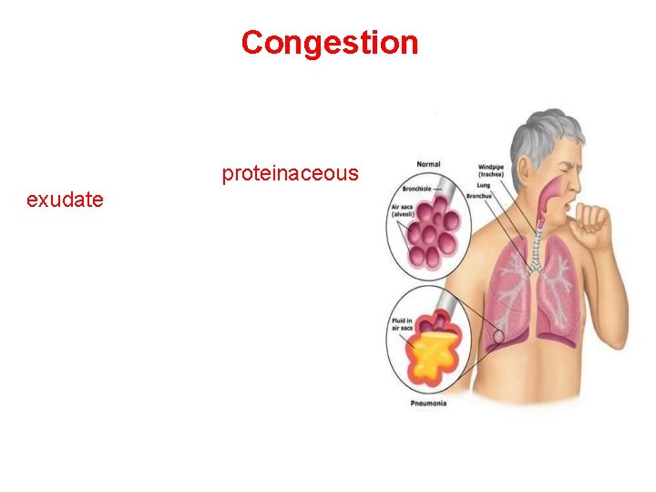 Congestion Presence of a proteinaceous • exudate—and often of bacteria—in the alveoli 