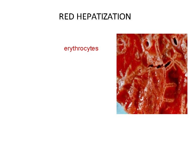 RED HEPATIZATION Presence of erythrocytes in the • cellular intraalveolar exudate Neutrophils are also