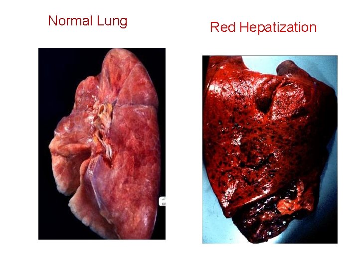 Normal Lung Red Hepatization 