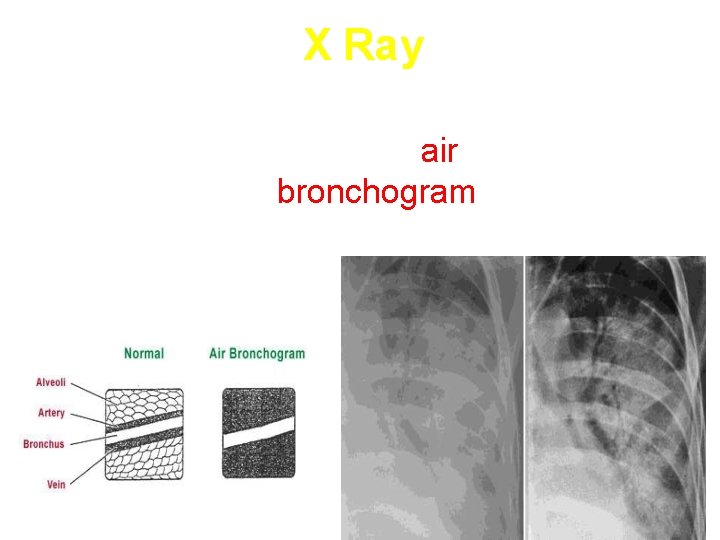 X Ray Homogenous opacity with air bronchogram 