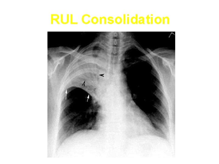 RUL Consolidation 