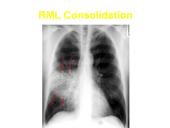 RML Consolidation 