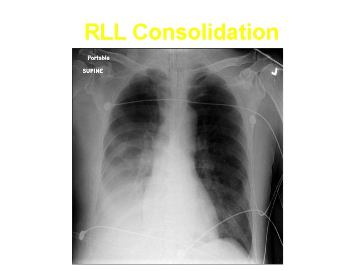 RLL Consolidation 