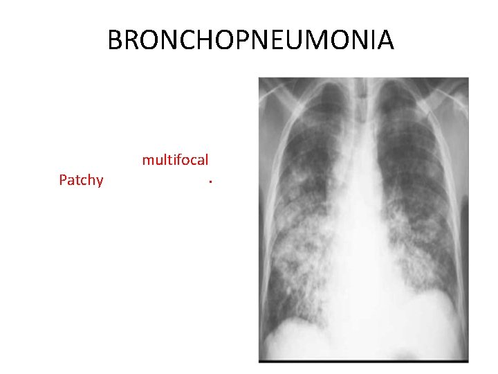 BRONCHOPNEUMONIA Centrilobular and • Peribronchiolar opacity pneumonia Tends to be multifocal • Patchy in