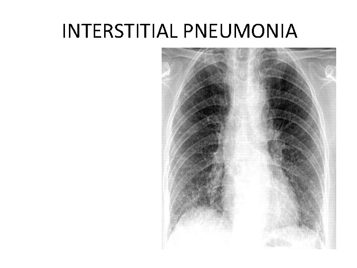 INTERSTITIAL PNEUMONIA Peribronchovascular • Infiltrate Mycoplasma , viral • 