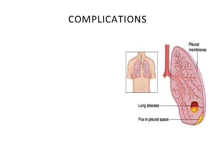 COMPLICATIONS Lung abscess • Para-pneumonic effusions • Empyema • Sepsis • Metastatic infections •