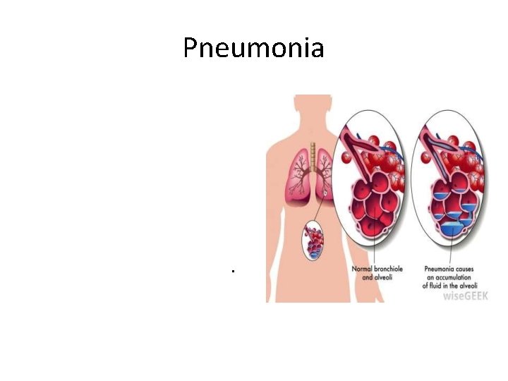 Pneumonia is an infection in one or both lungs. Pneumonia causes inflammation in thealveoli.