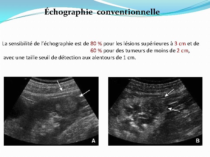 Échographie conventionnelle La sensibilité de l’échographie est de 80 % pour les lésions supérieures