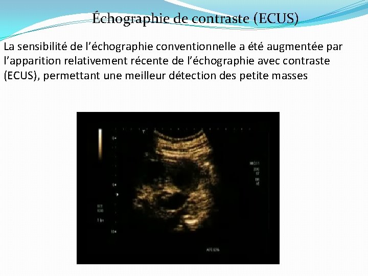 Échographie de contraste (ECUS) La sensibilité de l’échographie conventionnelle a été augmentée par l’apparition