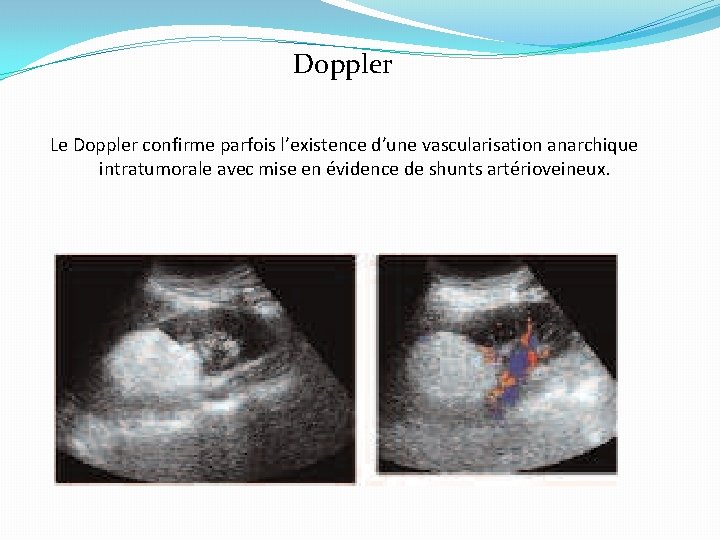 Doppler Le Doppler confirme parfois l’existence d’une vascularisation anarchique intratumorale avec mise en évidence