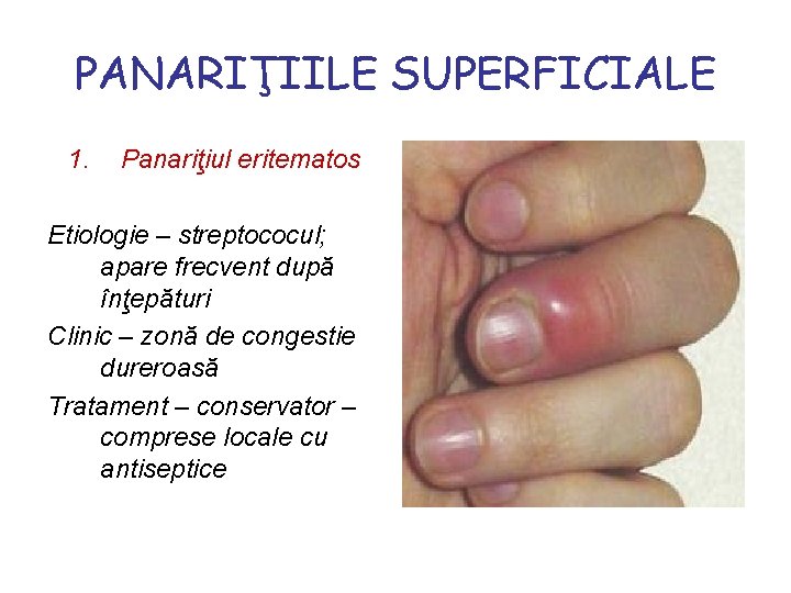 PANARIŢIILE SUPERFICIALE 1. Panariţiul eritematos Etiologie – streptococul; apare frecvent după înţepături Clinic –