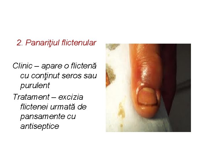 2. Panariţiul flictenular Clinic – apare o flictenă cu conţinut seros sau purulent Tratament